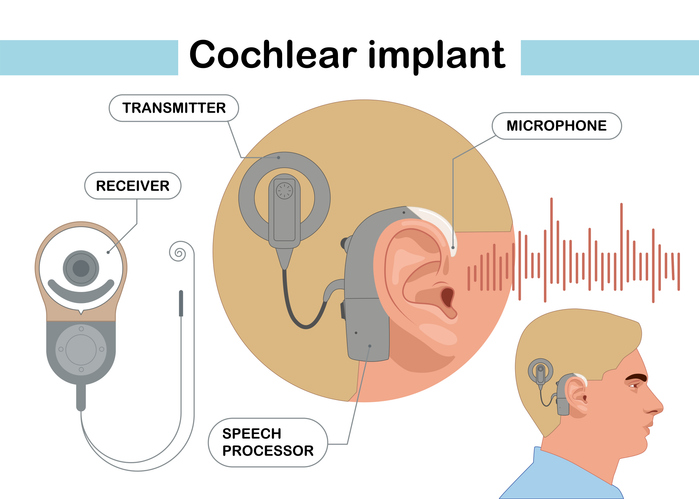 Cochlear implant device electrically stimulates nerve medical aid ear sound wave adults hard middle exam.